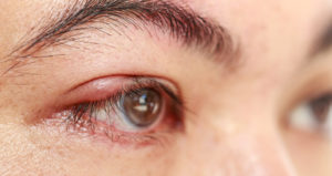 Chalazion