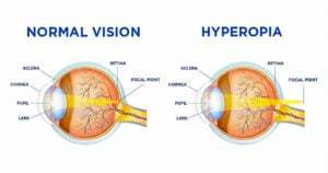 Hyperopia diagram comparing normal vision and hyperopia at Southwest Eye Institute