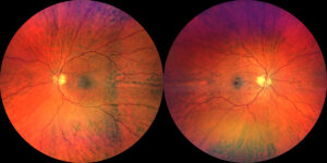 Side-by-side retinal photos showing the optic nerve and nerve fiber layer to interpret glaucoma test results