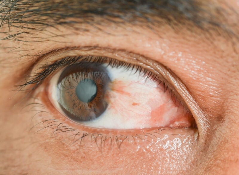 Close-up of a human eye, highlighting the eye's surface and surrounding structures, suitable for content about pterygium or general eye health.