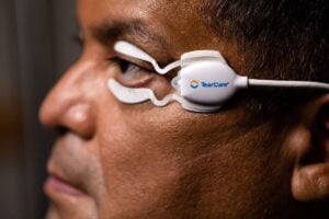 Close-up of a TearCare device warming the eyelids during MGD treatment—how to cure dry eyes permanently with targeted therapy