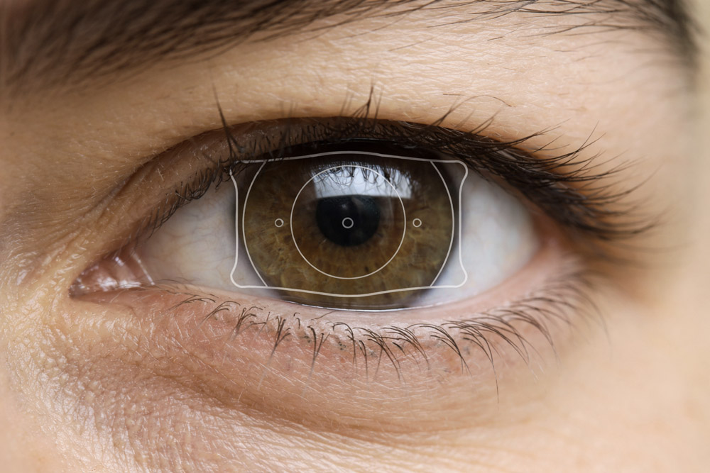 Close-up of eye showing EVO ICL implantable collamer lens for vision correction.