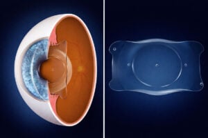 EVO-ICL implementation diagram from SOuthwest Eye Institute.