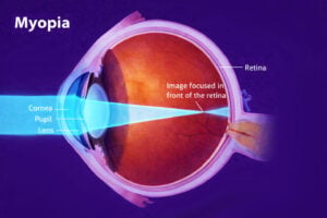 Myopia treatment diagram from Southwest Eye Institute.
