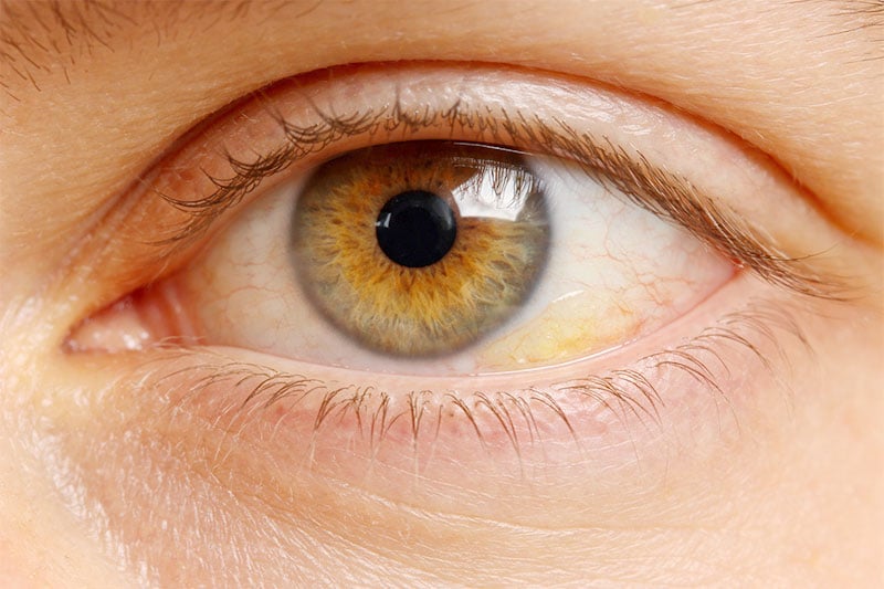 Yellow spot on eye caused by pinguecula, shown as a small raised yellow growth on the white of the eye near the cornea in natural lighting, often confused with pterygium.