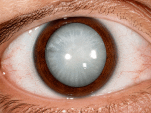 Extreme cataract in the left eye to show patients what are cataracts at Southwest Eye Institute.